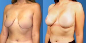 breast-augentation-b-a-1024x509