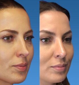 female-rhinoplasty