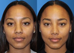 female-rhinoplasty-3