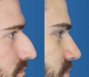 male-rhinoplasty-1024x891