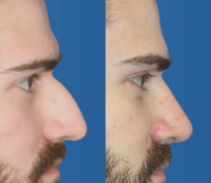 male-rhinoplasty