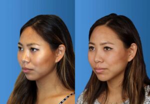 rhinoplasty-before-and-after-1024x707